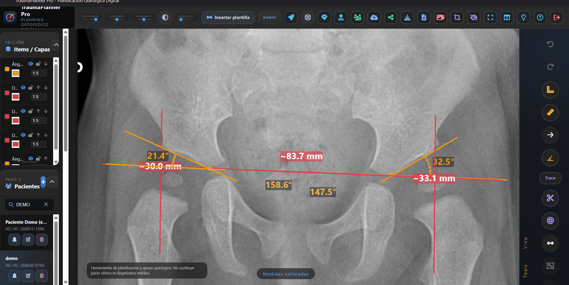 Interfaz de TraumaPlanner con una radiografía calibrada, mediciones de distancia y la biblioteca de implantes en la barra lateral.