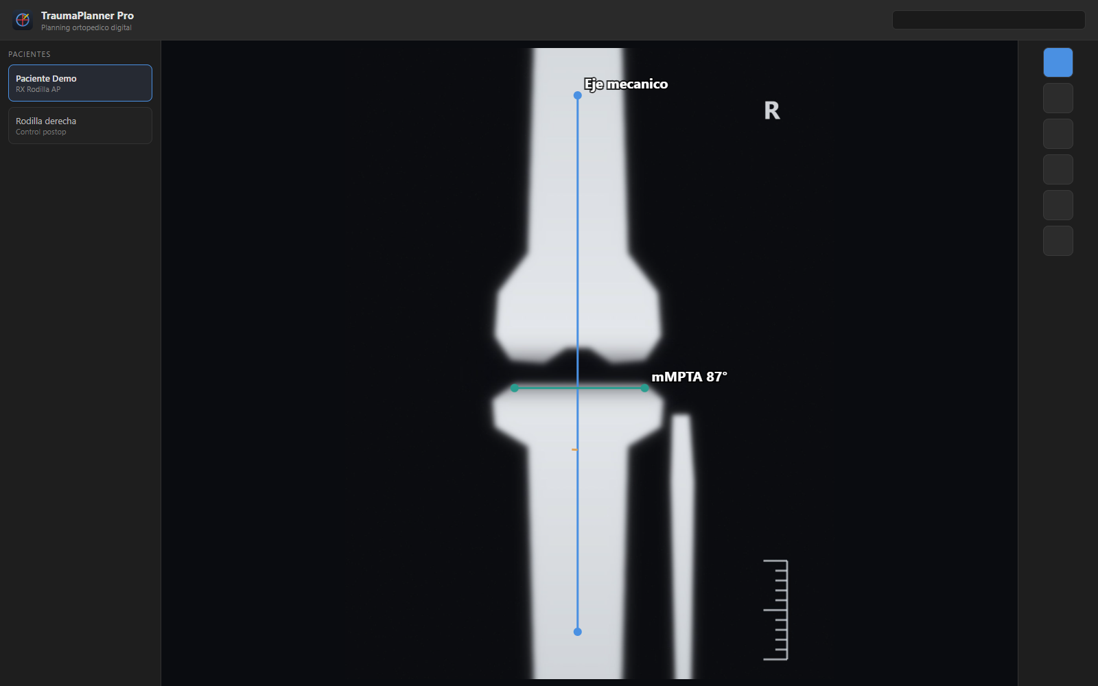 TraumaPlanner midiendo una radiografía de rodilla